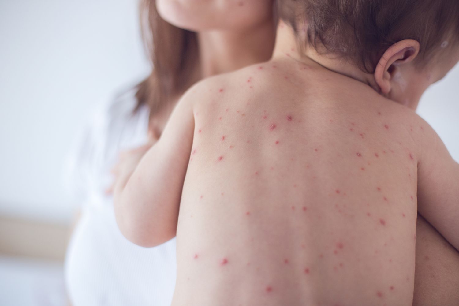 Bệnh sởi lây qua đường nào?